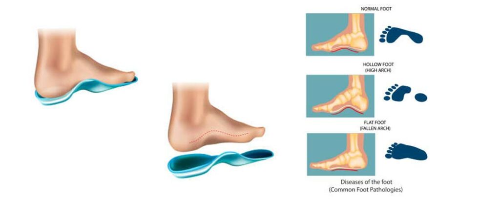 PRO-Blogf-for-Specially-Designed-Insoles-for-Flat-Feet