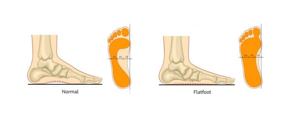 PRO-Blogf-for-Specially-Designed-Insoles-for-Flat-Feet-What-Causes